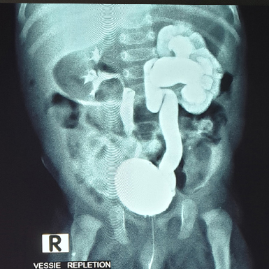 Reflux-vesico-ureteral