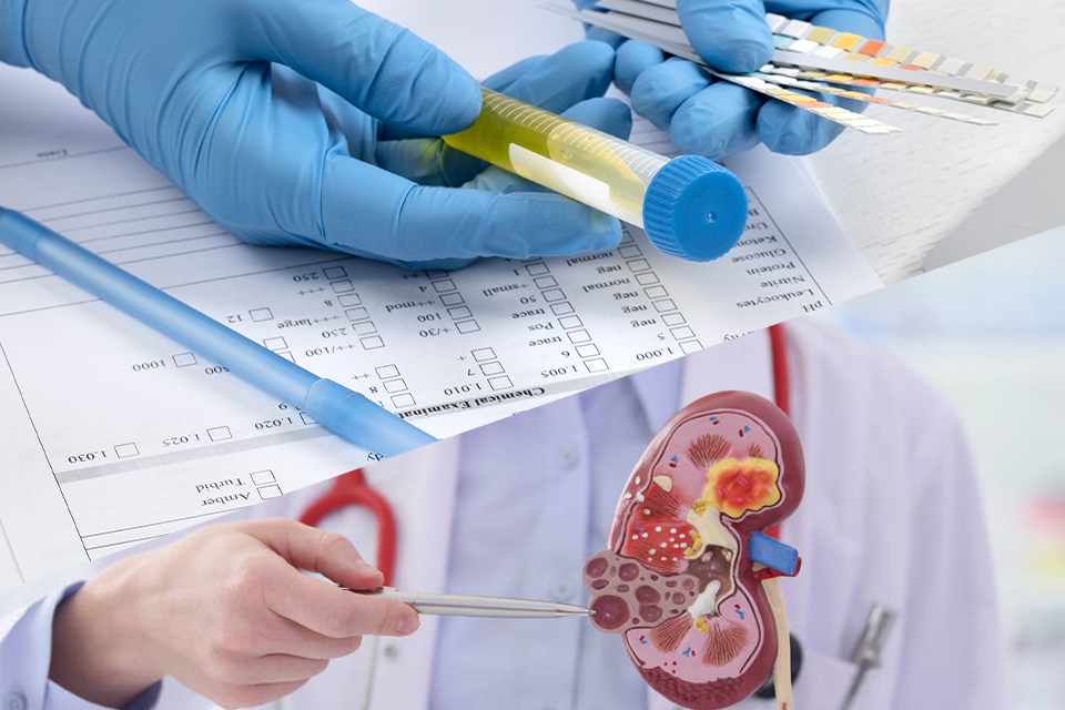 syndrome néphrotique idiopathique