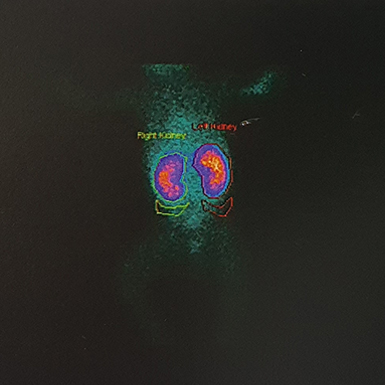 scintigraphie-renale